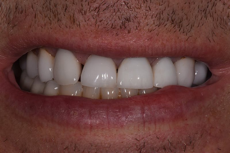 Patient Smile Before & After Gallery - Patient 148718 - Image 3