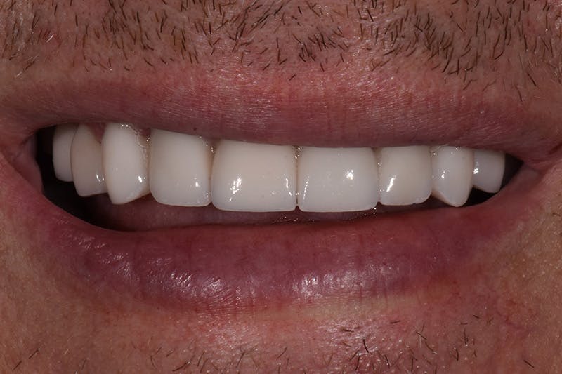 Patient Smile Before & After Gallery - Patient 148718 - Image 4