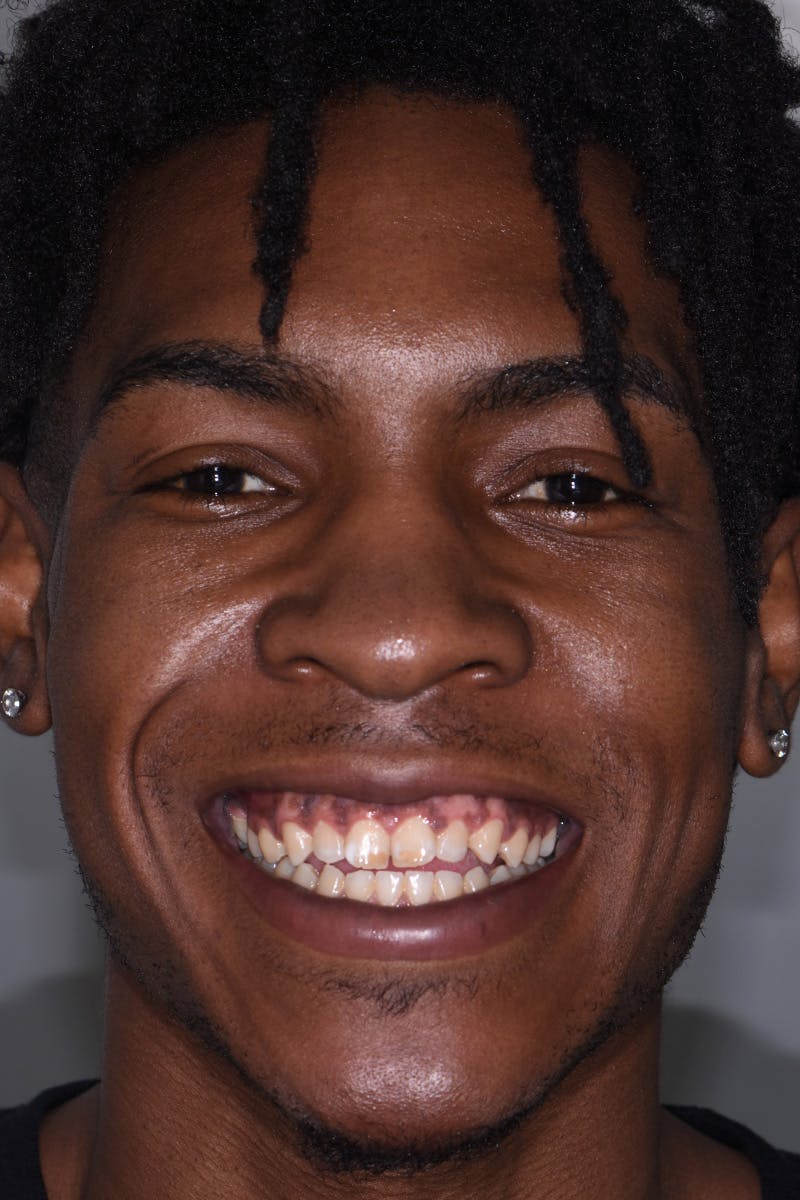 Patient Smile Before & After Gallery - Patient 348203 - Image 1