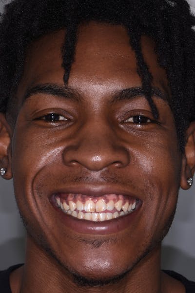 Patient Smile Before & After Gallery - Patient 348203 - Image 1