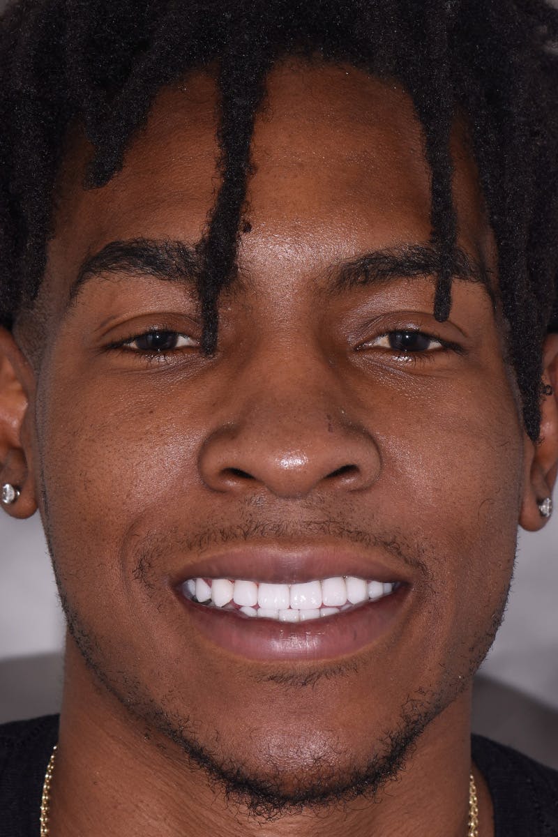 Patient Smile Before & After Gallery - Patient 348203 - Image 2