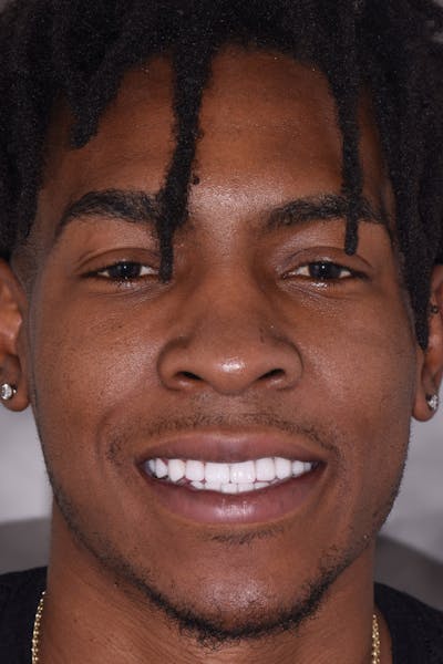 Patient Smile Before & After Gallery - Patient 348203 - Image 2