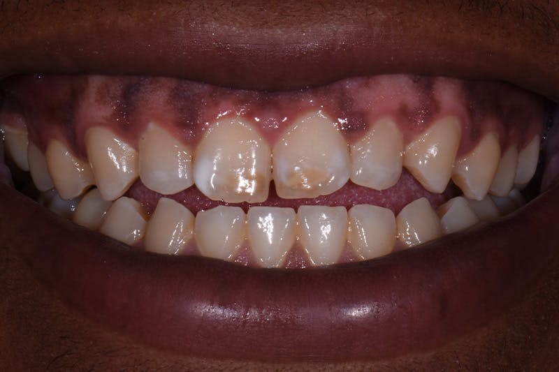 Patient Smile Before & After Gallery - Patient 348203 - Image 3