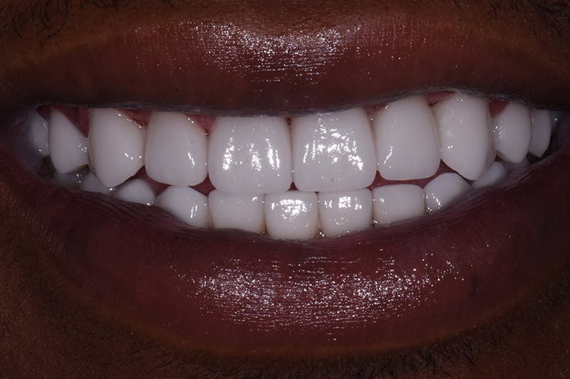 Patient Smile Before & After Gallery - Patient 348203 - Image 4
