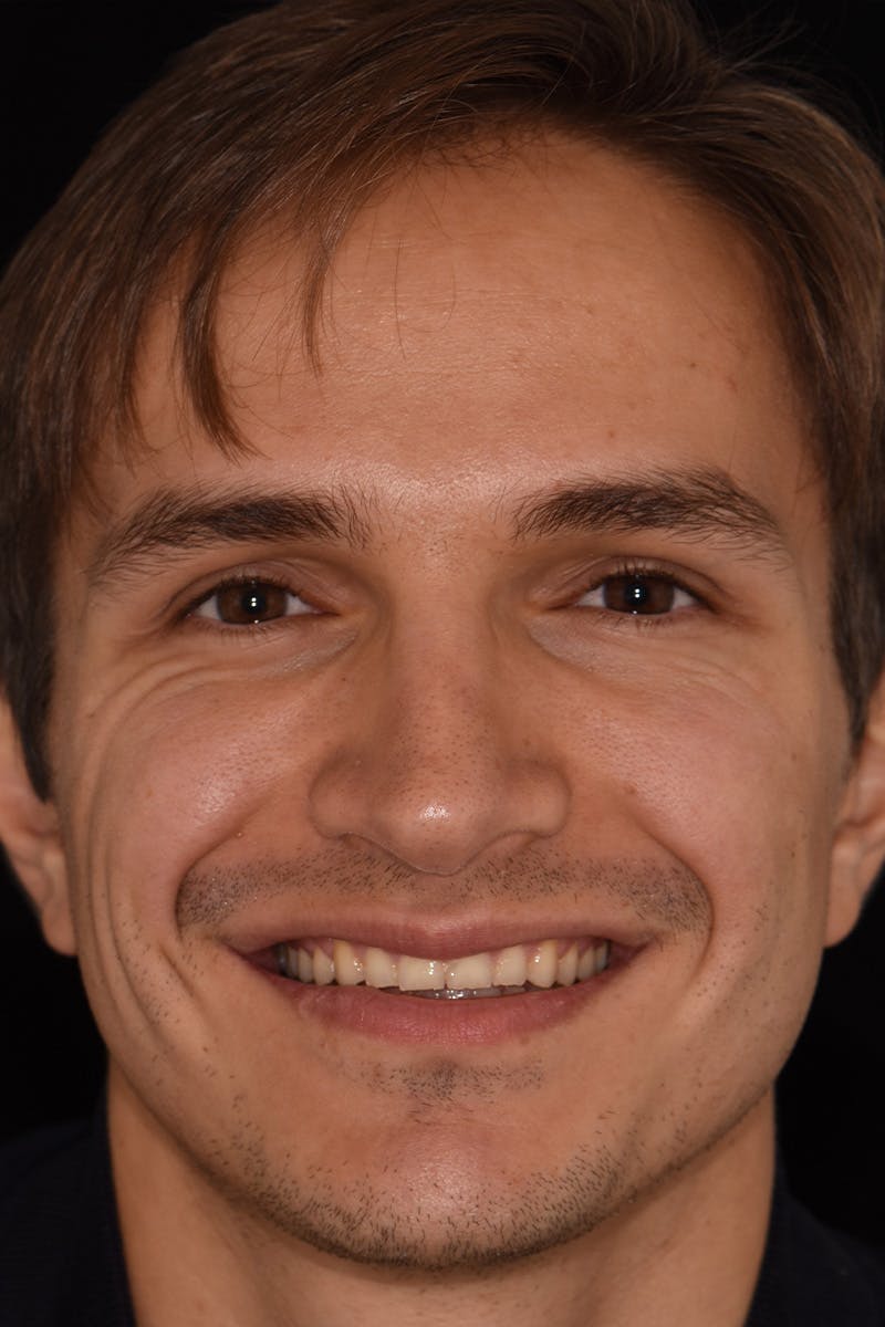 Patient Smile Before & After Gallery - Patient 223740 - Image 1