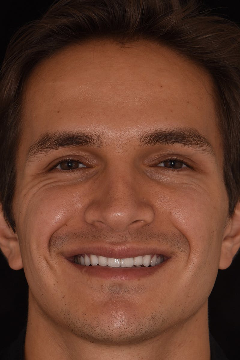 Patient Smile Before & After Gallery - Patient 223740 - Image 2