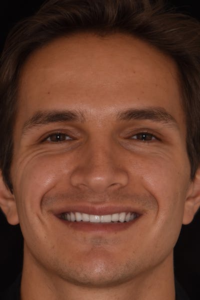 Patient Smile Before & After Gallery - Patient 223740 - Image 2