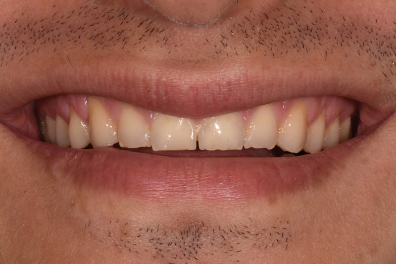Patient Smile Before & After Gallery - Patient 223740 - Image 3