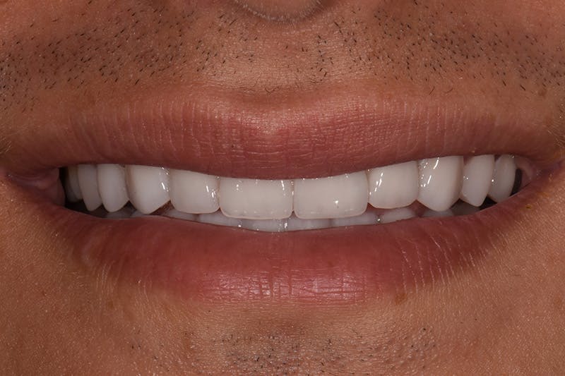 Patient Smile Before & After Gallery - Patient 223740 - Image 4