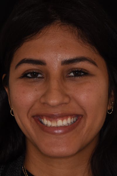 Patient Smile Before & After Gallery - Patient 174045 - Image 1