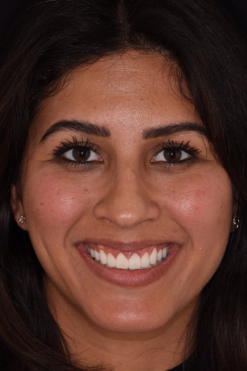 Patient Smile Before & After Gallery - Patient 174045 - Image 2