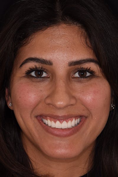 Patient Smile Before & After Gallery - Patient 174045 - Image 2