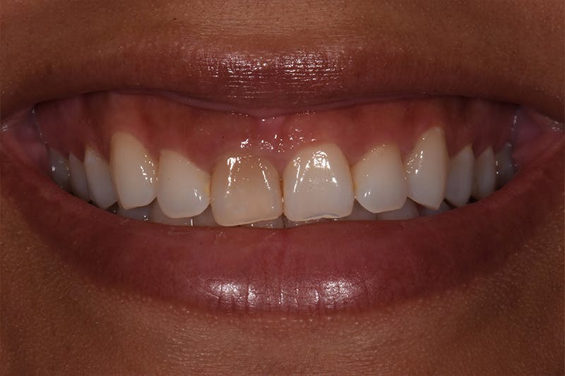 Patient Smile Before & After Gallery - Patient 174045 - Image 3