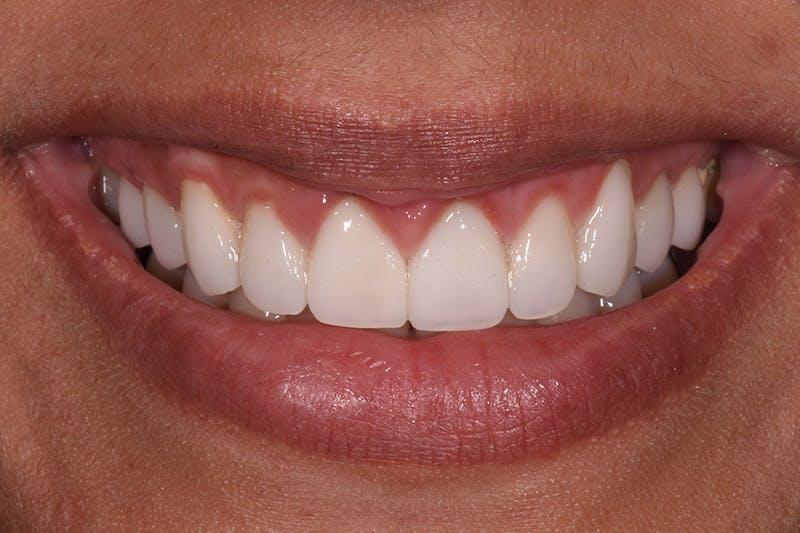 Patient Smile Before & After Gallery - Patient 174045 - Image 4