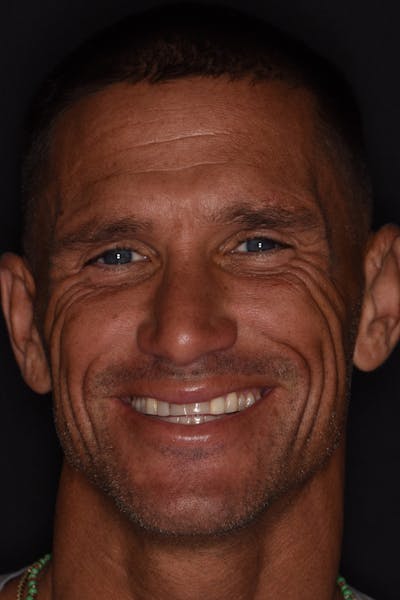 Patient Smile Before & After Gallery - Patient 406855 - Image 1