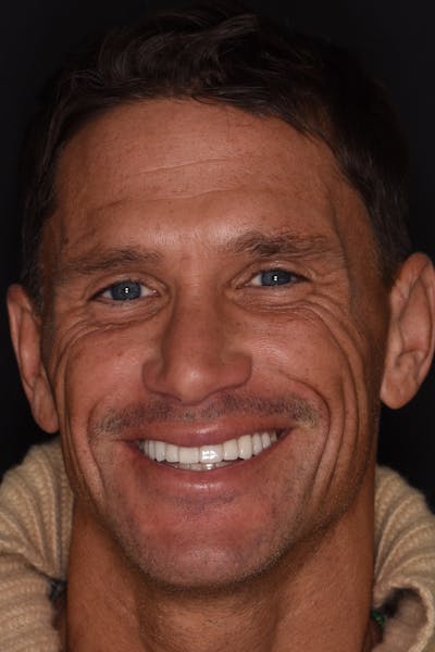 Patient Smile Before & After Gallery - Patient 406855 - Image 2