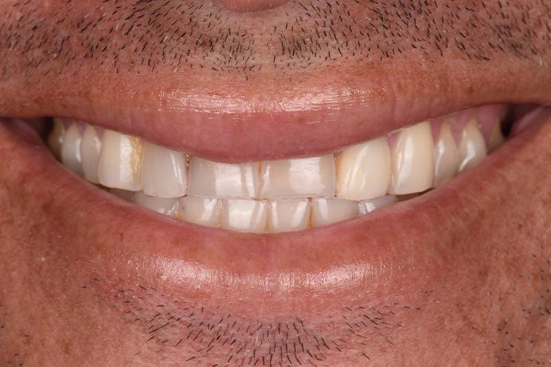 Patient Smile Before & After Gallery - Patient 406855 - Image 3