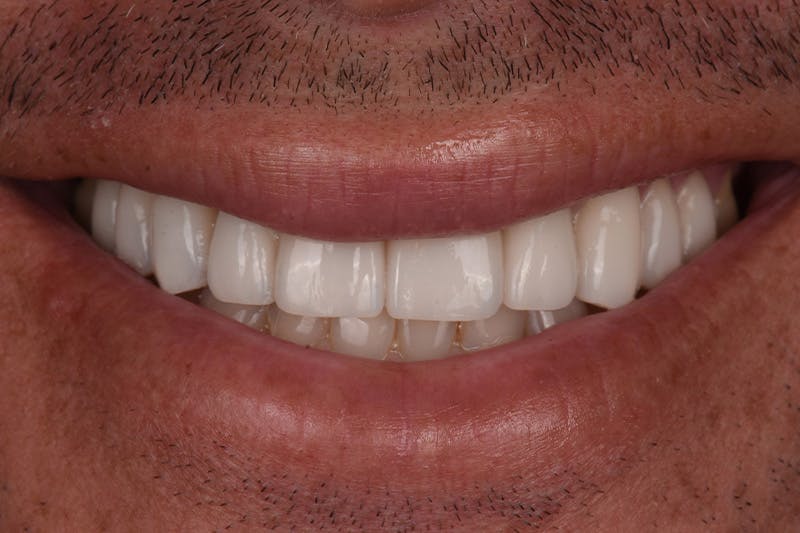 Patient Smile Before & After Gallery - Patient 406855 - Image 4