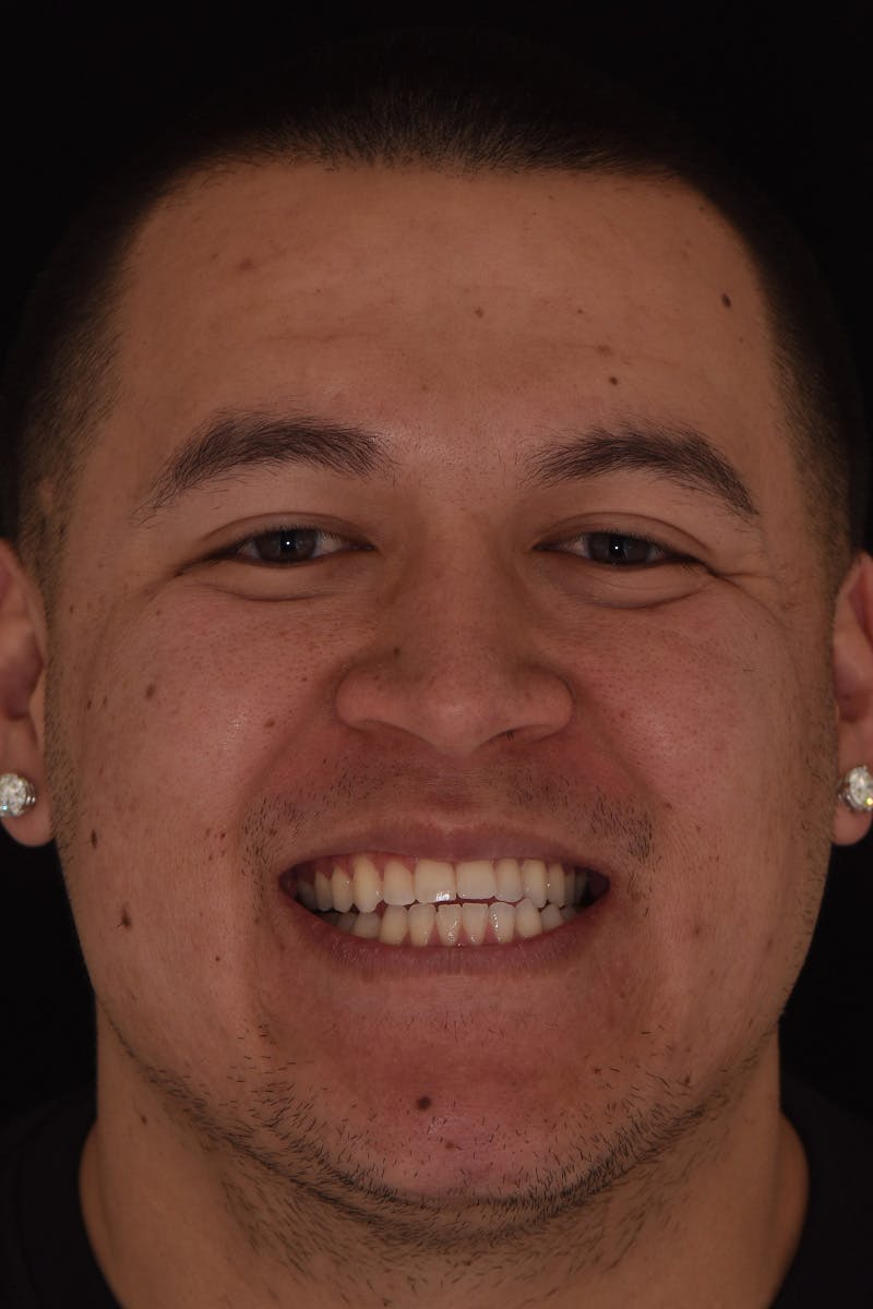 Patient Smile Before & After Gallery - Patient 239422 - Image 1