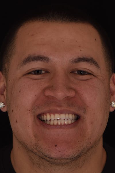 Patient Smile Before & After Gallery - Patient 239422 - Image 1