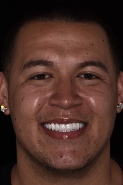 Patient Smile Before & After Gallery - Patient 239422 - Image 2