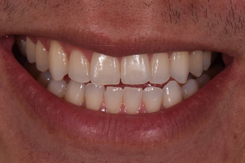 Patient Smile Before & After Gallery - Patient 239422 - Image 3