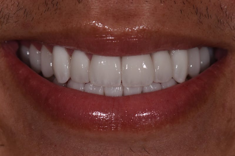 Patient Smile Before & After Gallery - Patient 239422 - Image 4