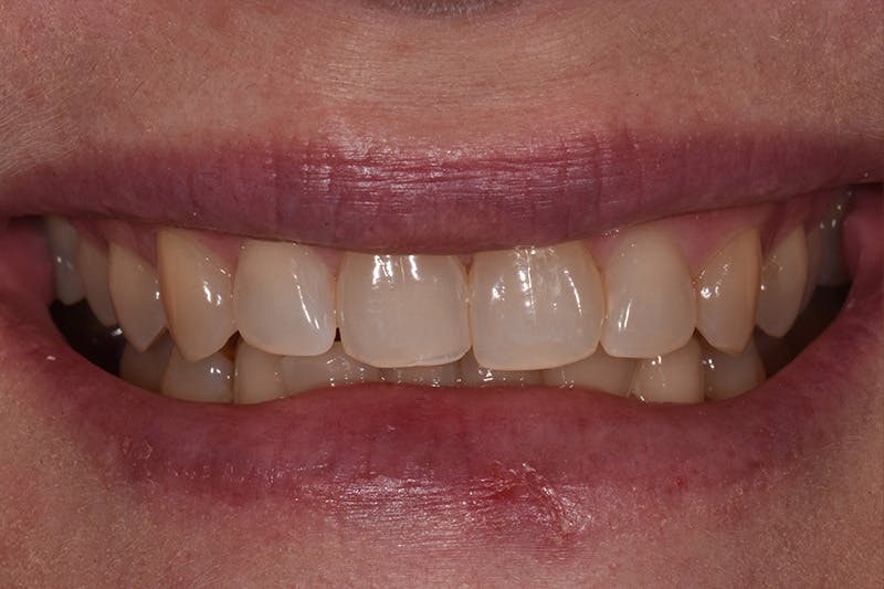 Patient Smile Before & After Gallery - Patient 248316 - Image 3