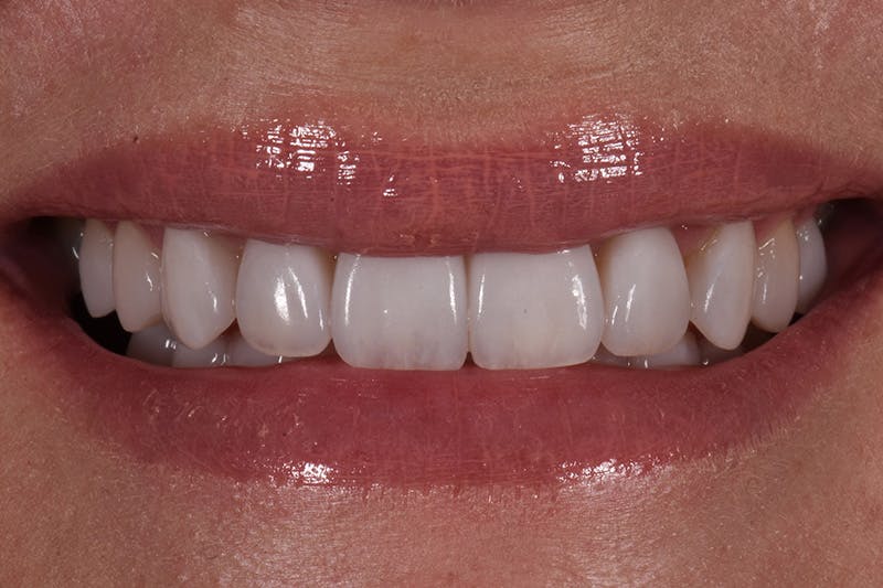 Patient Smile Before & After Gallery - Patient 248316 - Image 4