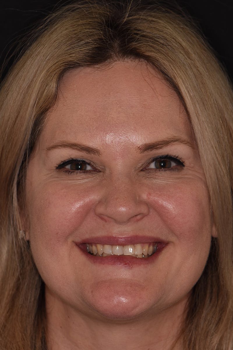 Patient Smile Before & After Gallery - Patient 248316 - Image 1