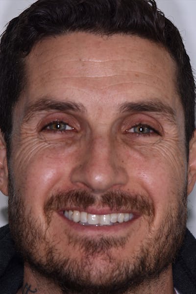 Patient Smile Before & After Gallery - Patient 238335 - Image 1