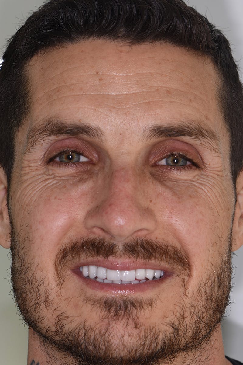 Patient Smile Before & After Gallery - Patient 238335 - Image 2