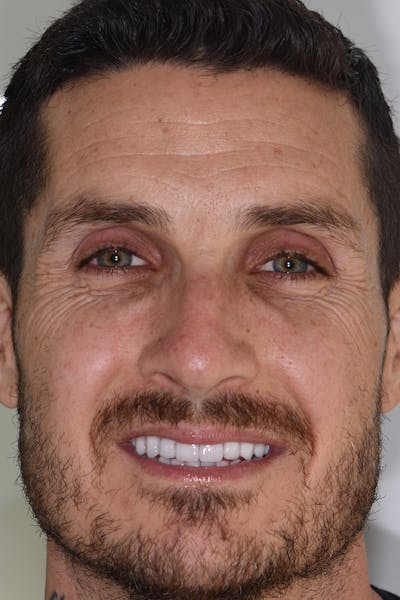 Patient Smile Before & After Gallery - Patient 238335 - Image 2