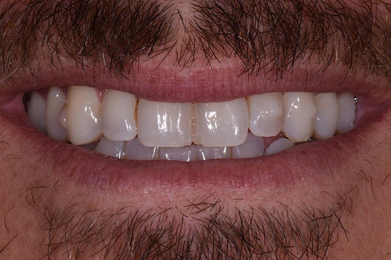 Patient Smile Before & After Gallery - Patient 238335 - Image 3