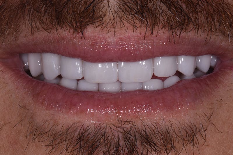 Patient Smile Before & After Gallery - Patient 238335 - Image 4