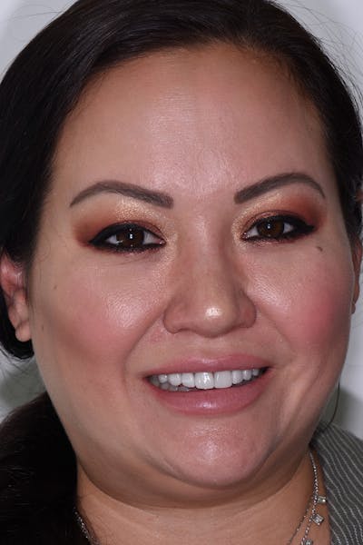 Patient Smile Before & After Gallery - Patient 377487 - Image 1