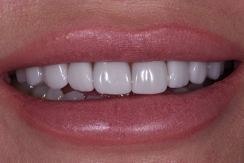 Patient Smile Before & After Gallery - Patient 377487 - Image 3