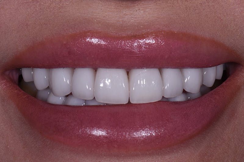 Patient Smile Before & After Gallery - Patient 377487 - Image 4
