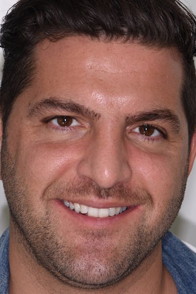 Patient Smile Before & After Gallery - Patient 162243 - Image 1