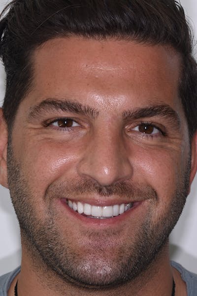 Patient Smile Before & After Gallery - Patient 162243 - Image 2