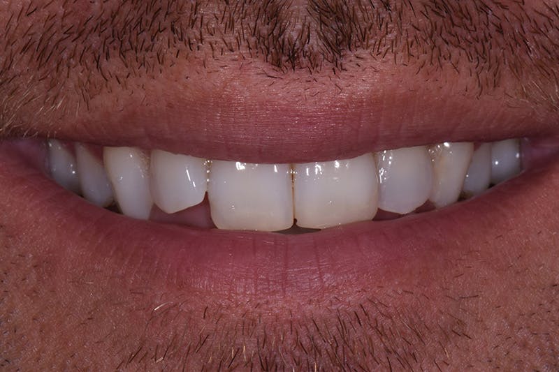 Patient Smile Before & After Gallery - Patient 162243 - Image 3