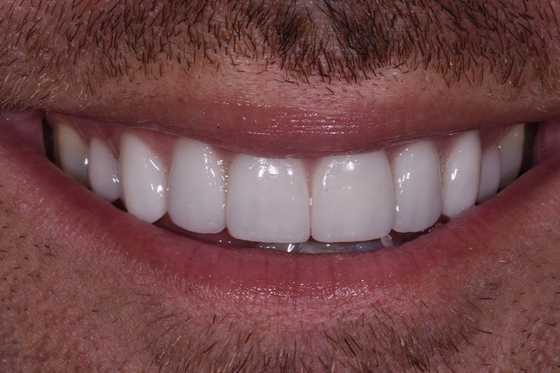 Patient Smile Before & After Gallery - Patient 162243 - Image 4
