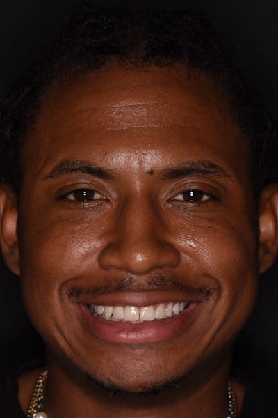 Patient Smile Before & After Gallery - Patient 310090 - Image 2