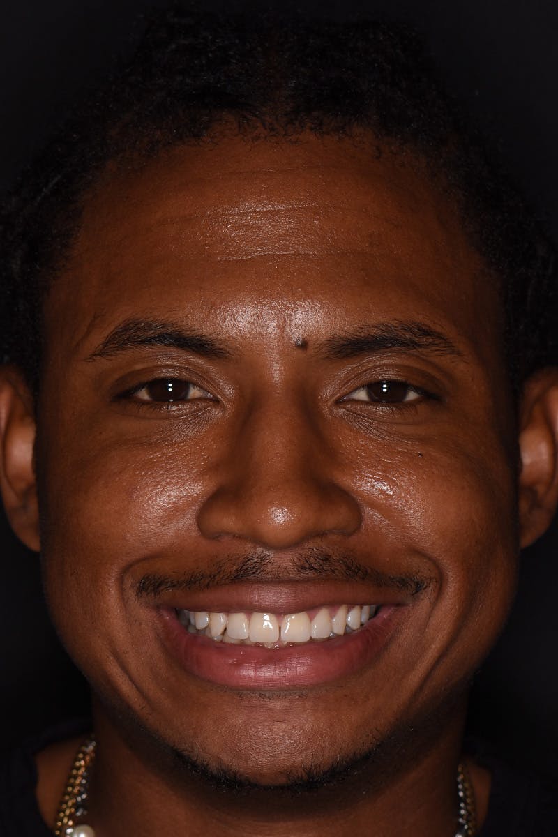 Patient Smile Before & After Gallery - Patient 310090 - Image 2