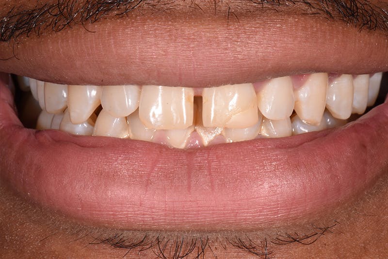 Patient Smile Before & After Gallery - Patient 310090 - Image 3