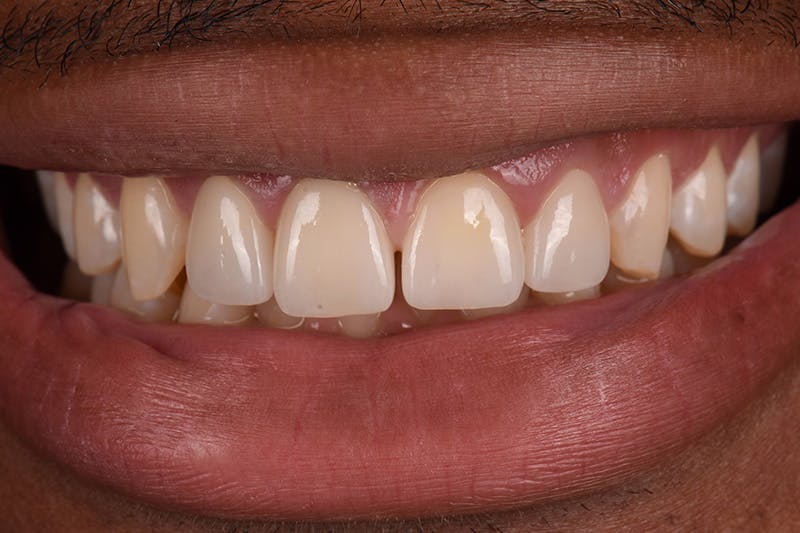 Patient Smile Before & After Gallery - Patient 310090 - Image 4