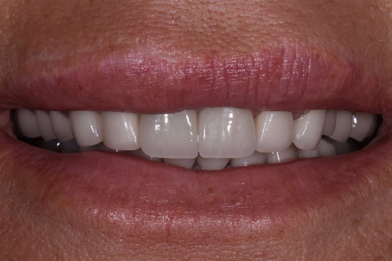 Patient Smile Before & After Gallery - Patient 251657 - Image 1
