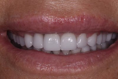 Patient Smile Before & After Gallery - Patient 251657 - Image 2