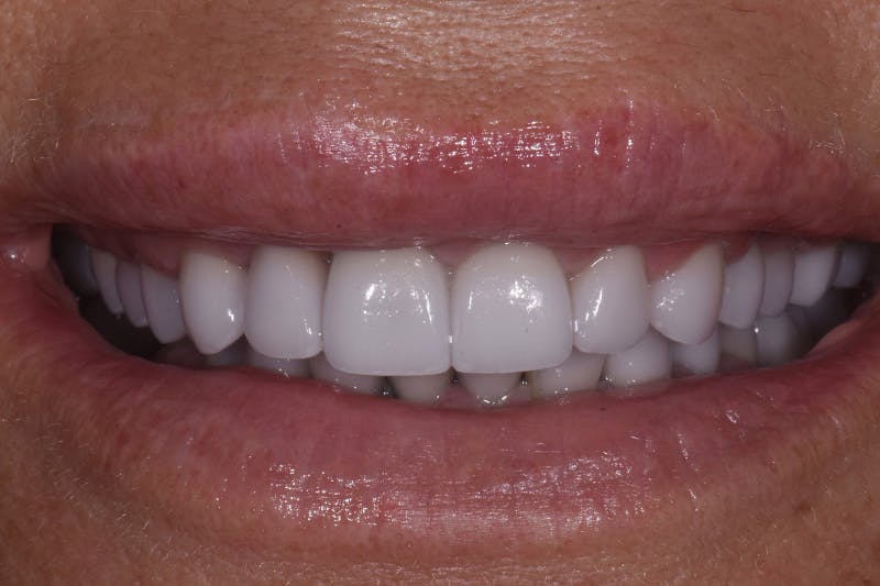 Patient Smile Before & After Gallery - Patient 251657 - Image 2