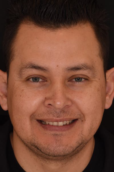 Patient Smile Before & After Gallery - Patient 164636 - Image 1